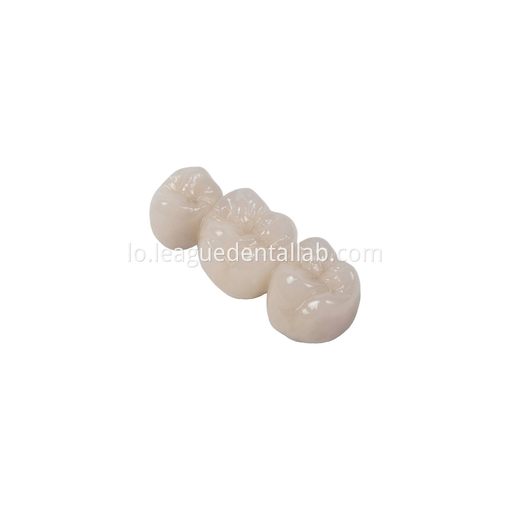 PFM,Metal crown,Fixed metal crown